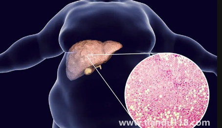 肝代謝不好吃什么調理3