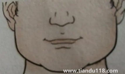 人中上的痣能去掉嗎1