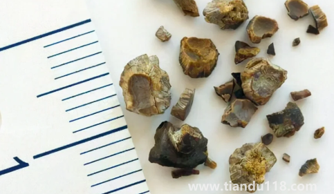 腎結(jié)石3mm×3mm多大（雙腎3×3mm小結(jié)石怎么辦）