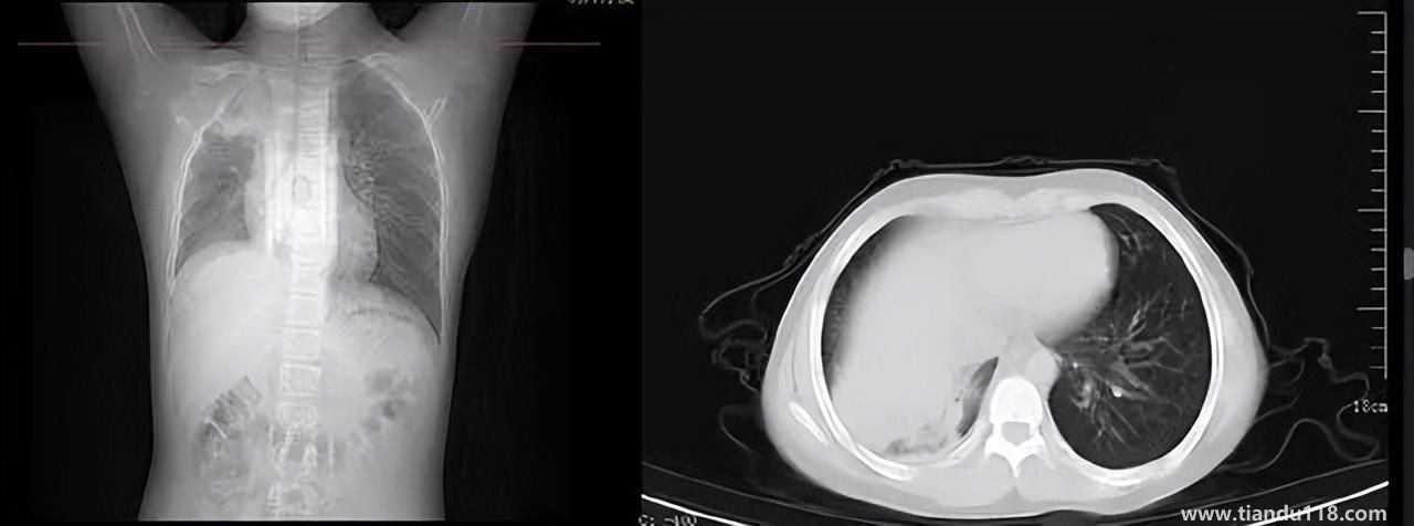 男孩咳嗽發(fā)熱在家硬扛成白肺（醫(yī)生表示以下幾種情況別硬“扛”）